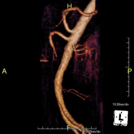 Angio-RM d'Aorta abdominal