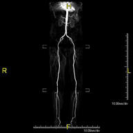 Angio RM Arterial extremidades inferiores