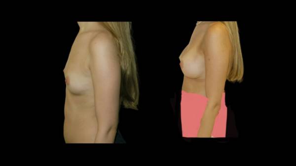 antes y después aumento de mama