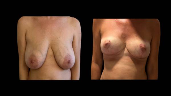 antes y después reducción de mama