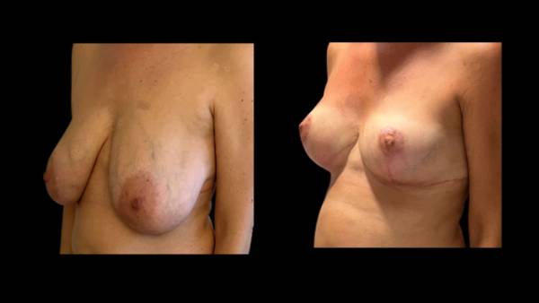 antes y después reducción de mama