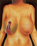 Diseño de la intervención de reducción mamaria