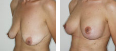 Ptosis mamaria. Técnica quirúrgica tipo I