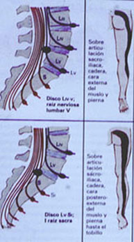 Tipos de hernia discal lumbar