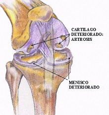 Artrosis-protesis