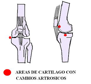 Artrosis-protesis 4