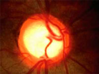 Nervio óptico excavado por glaucoma