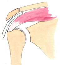 Corte frontal de un hombro normal a nivel de la inserción del tendón del supraespinoso en la cabeza humeral