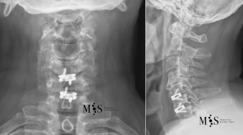 cirugia abierta cervical