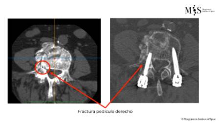 Caso clínico con estabilización percutánea de fractura vertebral inestable