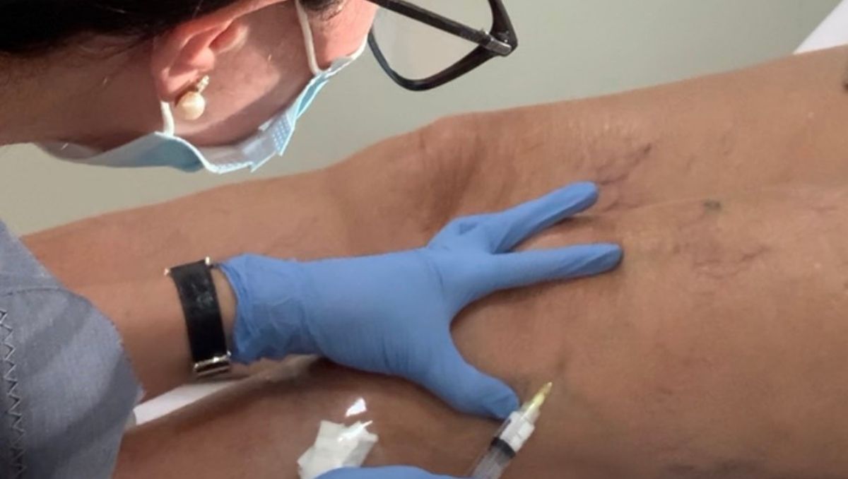 Escleroterapia
