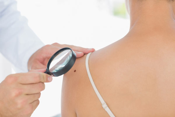 Revisión del melanoma