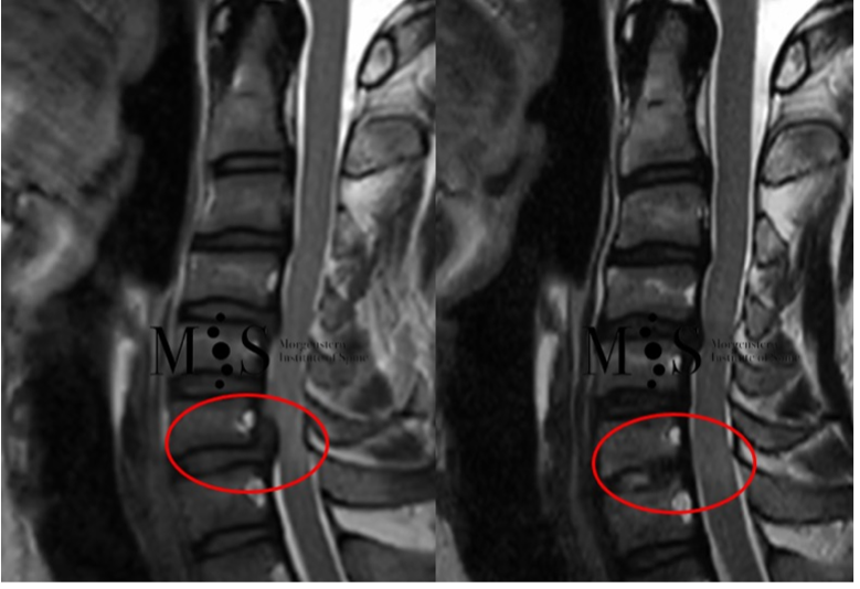cirugia-endoscopica-compresion-medular-cervical