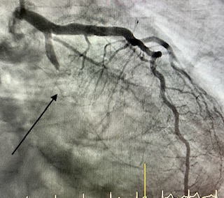 03-angioplastia-con-stent-infarto