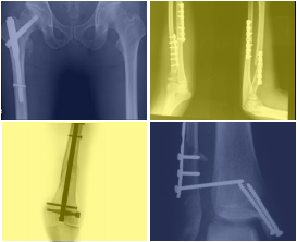 I Curso de Osteosíntesis