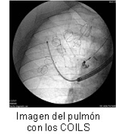 Imagen del pulmón con los COILS