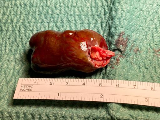 Foto2Tumor