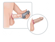 Dispositivo de vacío, eficaz solución para la disfunción eréctil