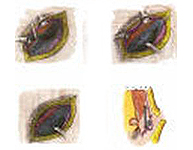 Hernioplastia según la técnica de Lichtenstein
