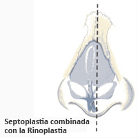 Septoplastia