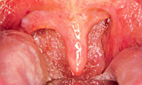 Gran hipertrofia por úvula