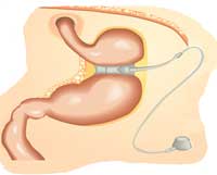 Gastroplastia con banda ajustable
