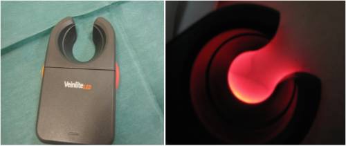tratamiento varices y aranas vasculares