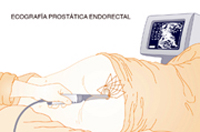 biopsia prostata