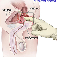 tacto_rectal