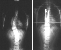 Radiografías de una escoliosis o desviación lateral de la columna, antes y después de la intervención quirúrgica para corregirla