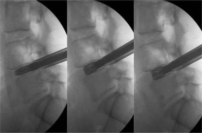 Imágenes fluoroscópicas de la inserción del implante expandible en un disco colapsado y su expansión progresiva restaurando la altura original del disco intervertebral (de izquierda a derecha)