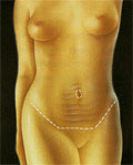 Representación de la incisión de abdominoplastia