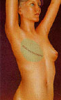 Mujer con un pecho extirpado