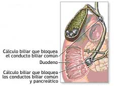 Coledocolitiasis