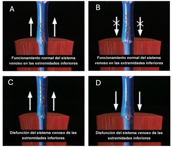 tratamiento vairces de piernas