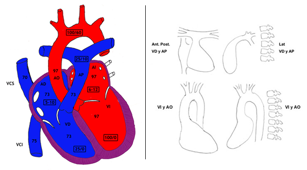 Cateterismo cardíaco y angiografía
