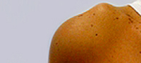 Reparación artroscópica acromio-clavicular de hombro