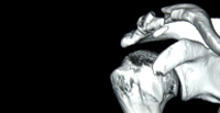 Reparación artroscópica de las fracturas de 1/3 distal clavícula