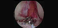 Tratamiento de las fracturas de rodilla con técnicas artroscópicas