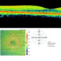 OCT-Retiografia-prueba-diagnostica-oftalmologia-oftalnova-barcelona-200x200