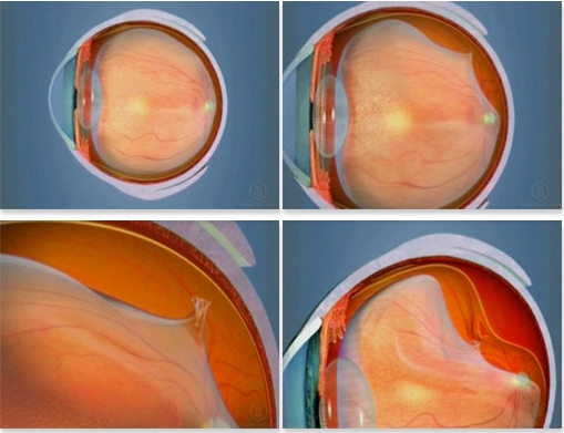 Oftalnova-oftalmologos-barcelona-especialistas-desprendimiento-de-retina