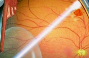 Oftalnova-oftalmologos-especializados-en-desprendimiento-retrina-fotocoagulacion-300x198