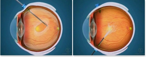 Oftalnova-oftalmologos-barcelona-desprendimiento-retina-moscas-volantes-imagen