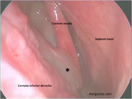 Tratamiento quirúrgico poliposis nasal