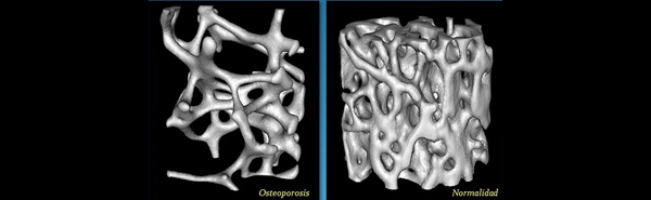 Osteoporosis__