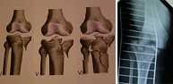 Fracturas de la rodilla