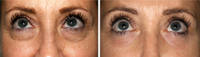 Blefaroplastia_02