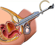 Resección transuretral de próstata