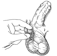 Fijación y aislamiento del deferente del cordón espermático