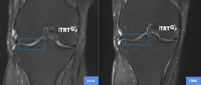Regeneración de cartílago con células madre cultivadas